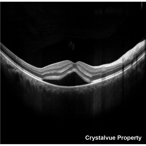 VISION 700 Automatic Optical Coherence Tomography - Crystalvue