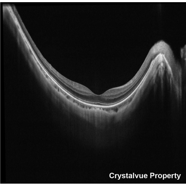 VISION 700 Automatic Optical Coherence Tomography - Crystalvue