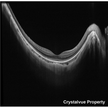 VISION 700 Automatic Optical Coherence Tomography - Crystalvue