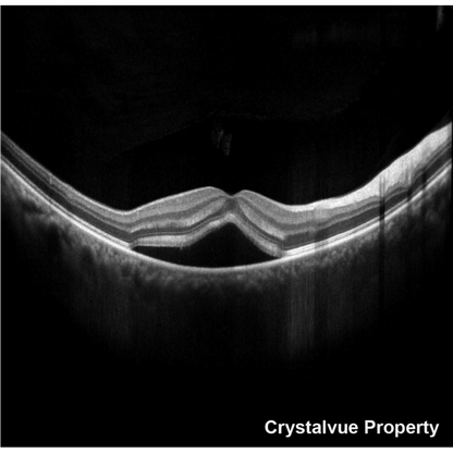 VISION 700 Automatic Optical Coherence Tomography - Crystalvue