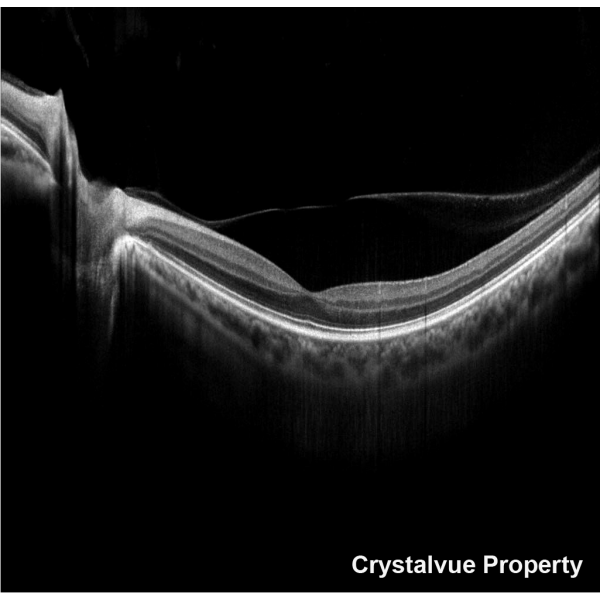 VISION 700 Automatic Optical Coherence Tomography - Crystalvue