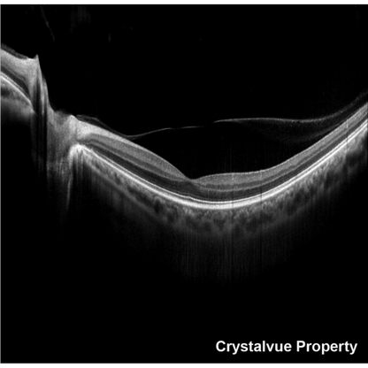 VISION 700 Automatic Optical Coherence Tomography - Crystalvue