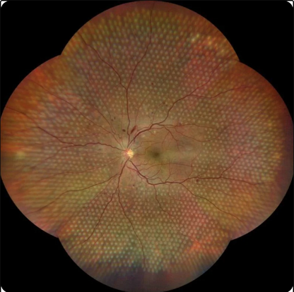 Navilas 577s Laser System - OD-OS