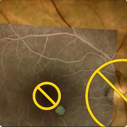 Navilas 577s Laser System - OD-OS