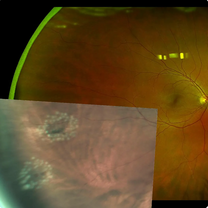 Navilas 577s Laser System - OD-OS