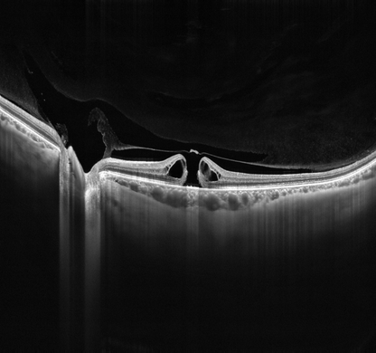 DREAM OCT™ - Intalight
