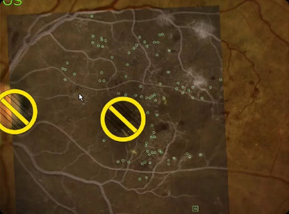 Navilas 577s Laser System - OD-OS